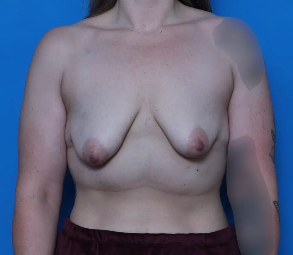 Breast Augmentation/Lift - Case 8442 - Before