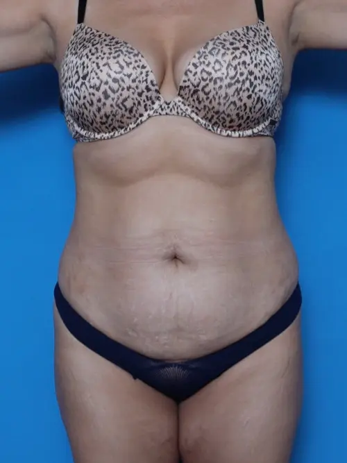 Liposuction - Case 8494 - Before