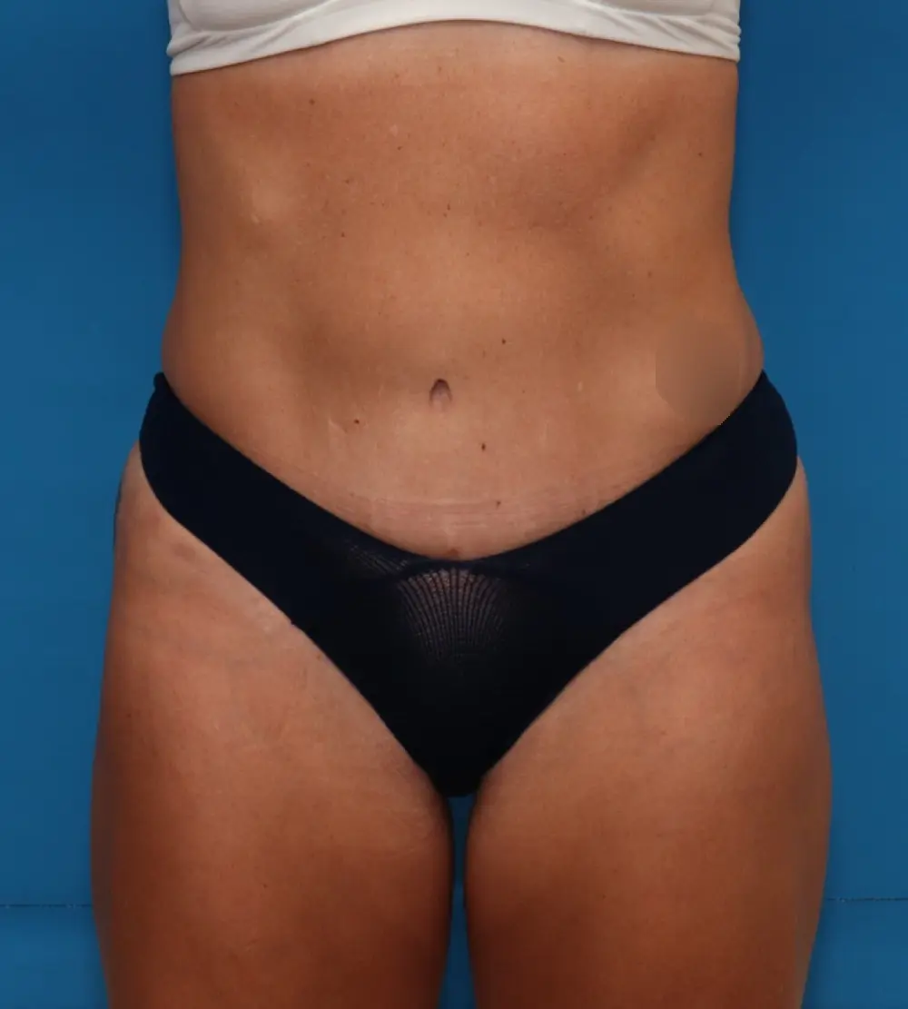 Tummy Tuck - Case 8522 - After