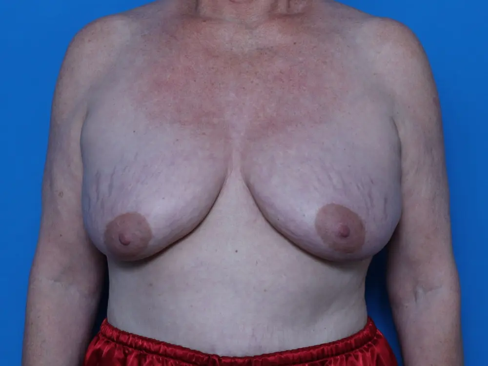 Breast Augmentation/Lift - Case 8530 - Before