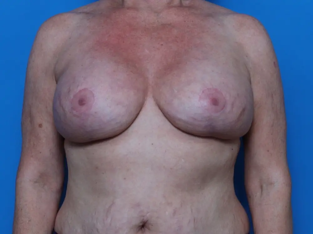 Breast Augmentation/Lift - Case 8530 - After